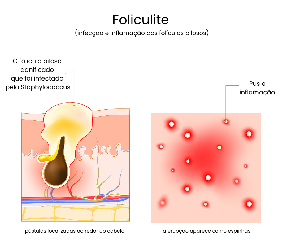 Foliculite vaginal : o que é, causas e como tratar – amai